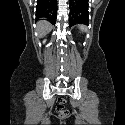 File:Acute pancreatitis (Radiopaedia 20829-20744 Coronal C+ portal venous phase 44).jpg
