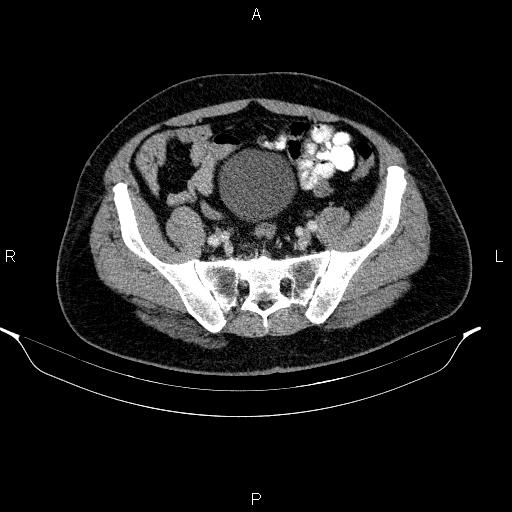 Acute pancreatitis (Radiopaedia 85390-101010 Axial C+ portal venous phase 84).jpg
