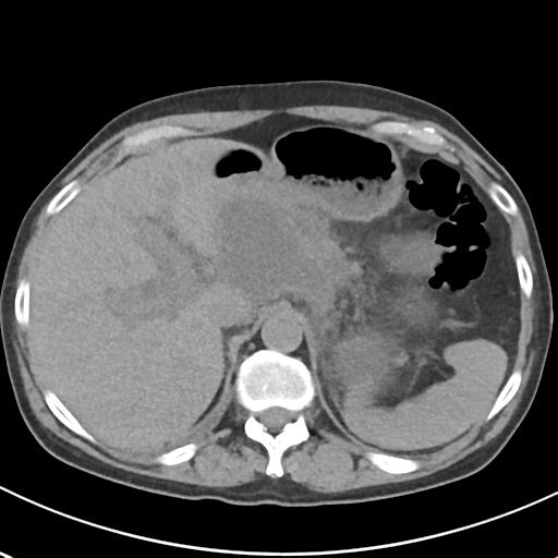 File:Acute pancreatitis and walled-off necrosis (Radiopaedia 29888-30404 Axial non-contrast 17).jpg