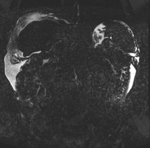 Acute portal vein thrombosis (Radiopaedia 73198-83925 Coronal Heavily T2 thin cuts 58).jpg