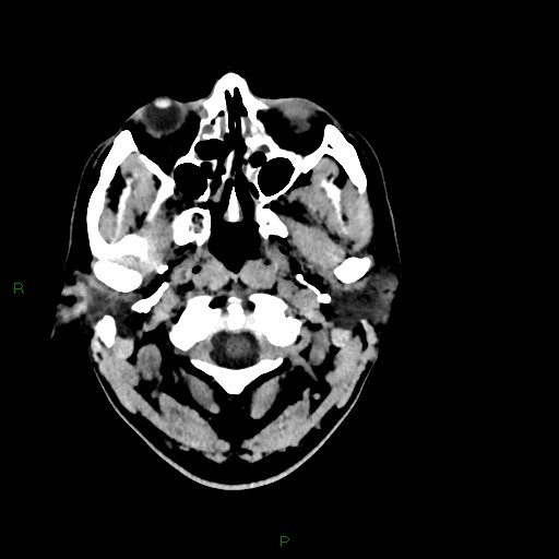 Acute posterior cerebral artery territory infarct (Radiopaedia 79329-92393 Axial non-contrast 7).jpg