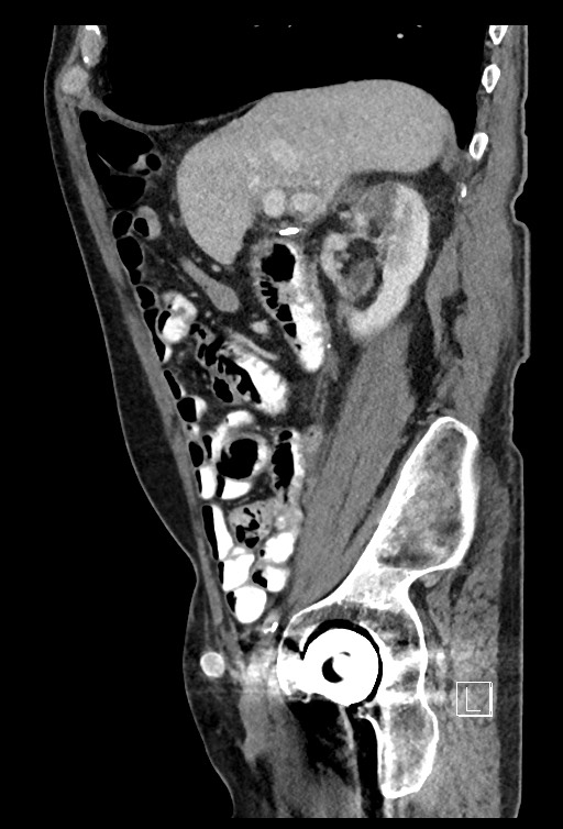 Acute renal infarction - rim capsular enhancement (Radiopaedia 59833-67270 Sagittal C+ portal venous phase 62).jpg