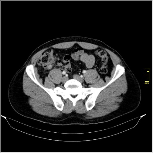 File:Acute right sided diverticulitis (Radiopaedia 65249-74268 Axial C+ portal venous phase 58).JPG