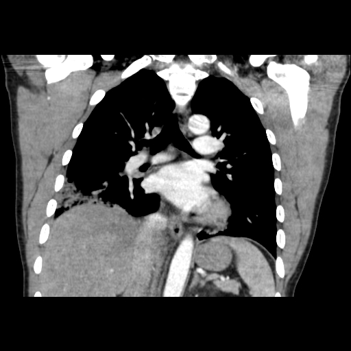 Acute segmental pulmonary emboli and pulmonary infarction (Radiopaedia 62264-70444 Coronal C+ CTPA 30).jpg