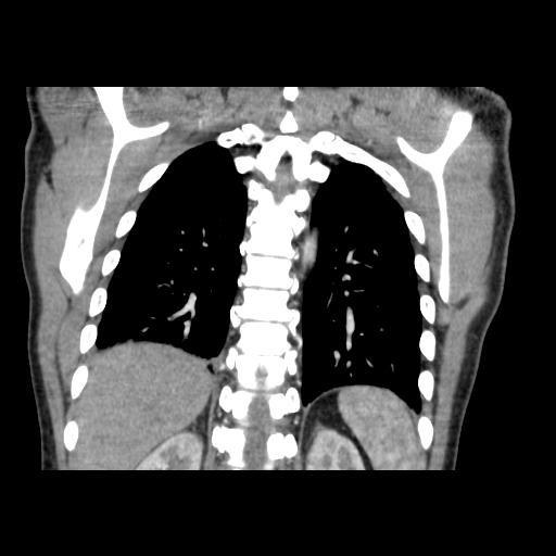 Acute segmental pulmonary emboli and pulmonary infarction (Radiopaedia 62264-70444 Coronal C+ CTPA 43).jpg