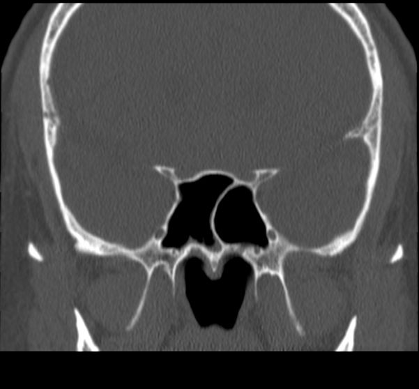Acute sinusitis (Radiopaedia 23161-23215 Coronal bone window 48).jpg