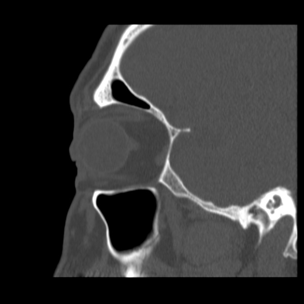 Acute sinusitis (Radiopaedia 23161-23215 Sagittal bone window 17).jpg