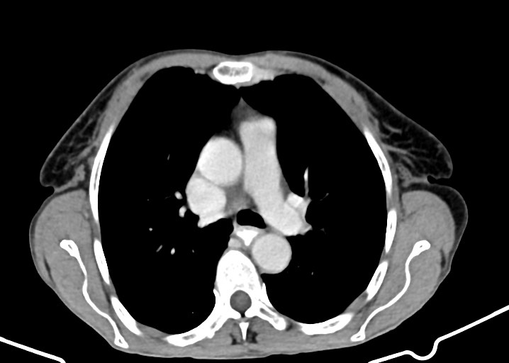 Acute small bowel (ileal) volvulus (Radiopaedia 71740-82139 Axial C+ portal venous phase 2).jpg