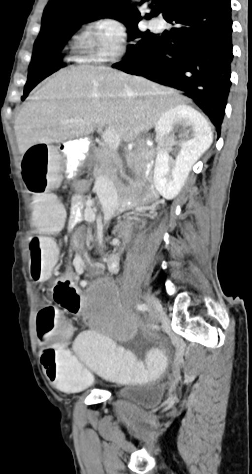 Acute small bowel (ileal) volvulus (Radiopaedia 71740-82139 Sagittal C+ portal venous phase 105).jpg