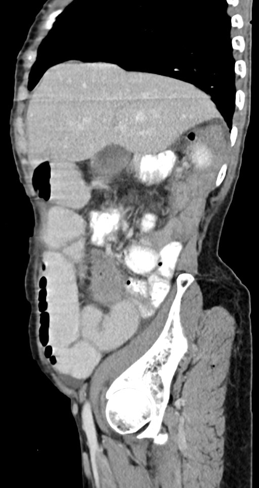 Acute small bowel (ileal) volvulus (Radiopaedia 71740-82139 Sagittal C+ portal venous phase 121).jpg