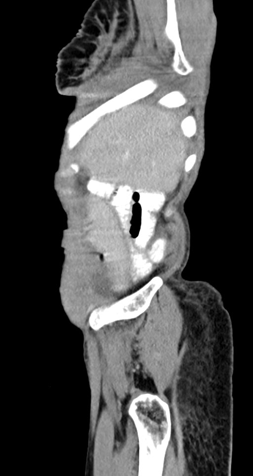 Acute small bowel (ileal) volvulus (Radiopaedia 71740-82139 Sagittal C+ portal venous phase 143).jpg
