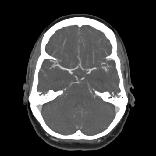 Acute subarachnoid hemorrhage and accessory anterior cerebral artery (Radiopaedia 69231-79009 D 24).jpg