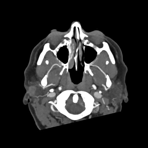 Acute subarachnoid hemorrhage and accessory anterior cerebral artery (Radiopaedia 69231-79009 D 5).jpg