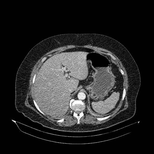 File:Acute superior mesenteric artery occlusion (Radiopaedia 51288-56960 Axial C+ arterial phase 14).jpg