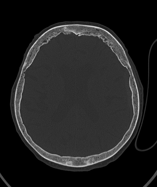 Acute traumatic subdural hematoma (Radiopaedia 82921-97257 Axial bone window 47).jpg