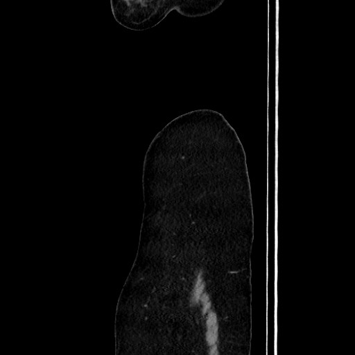 Acute uncomplicated appendicitis (Radiopaedia 73704-84499 Sagittal C+ portal venous phase 28).jpg