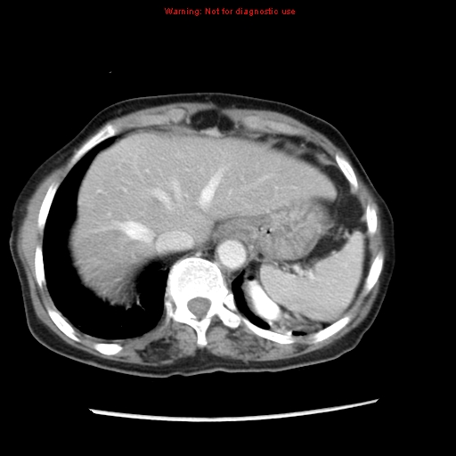 File:Adenocarcinoma of the colon (Radiopaedia 8191-9039 Axial liver window 13).jpg