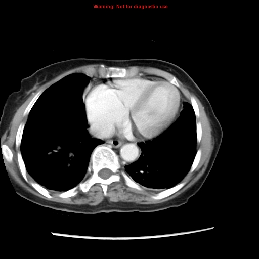 File:Adenocarcinoma of the colon (Radiopaedia 8191-9039 Axial liver window 5).jpg