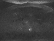 Adenocarcioma of rectum- T1 lesion (Radiopaedia 36921-38546 Axial DWI 78).png