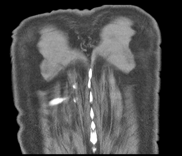 Adenocarcioma of rectum- T1 lesion (Radiopaedia 36921-38547 Coronal C+ arterial phase 58).png