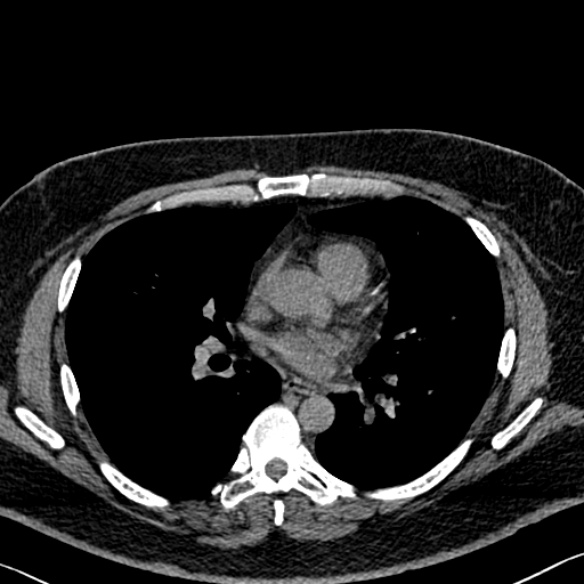 Adenoid cystic carcinoma of the trachea (Radiopaedia 49042-54137 Axial non-contrast 185).jpg