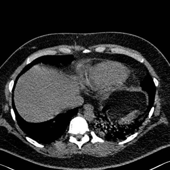 Adenoid cystic carcinoma of the trachea (Radiopaedia 49042-54137 Axial non-contrast 276).jpg