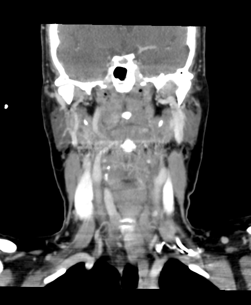 Adenoid cystic tumor of palate (Radiopaedia 46980-51518 Coronal C+ delayed 38).png