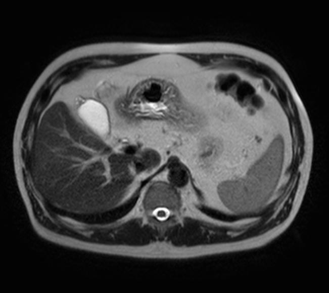 File:Adenomyomatosis of the gallbladder fundus (Radiopaedia 56727-63518 Axial T2 1).jpg