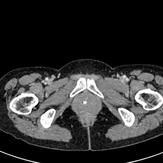 Adhesional small bowel obstruction (Radiopaedia 48397-53305 Axial C+ portal venous phase 98).jpg