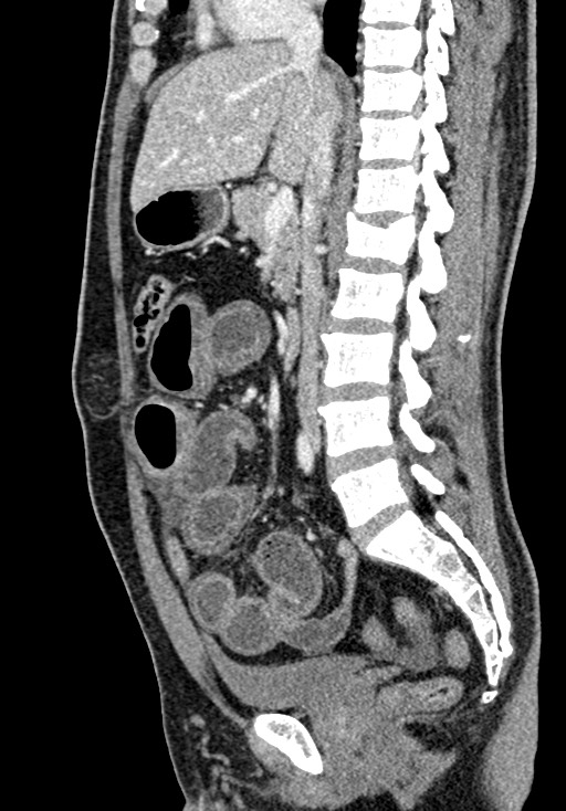Adhesional small bowel obstruction (Radiopaedia 58900-66131 Sagittal C+ portal venous phase 117).jpg