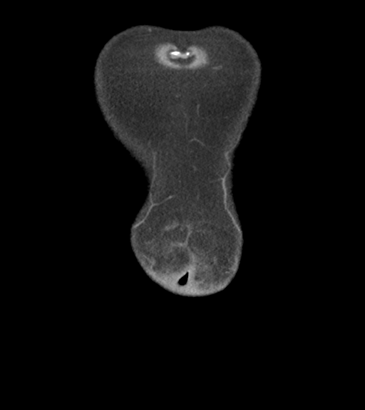 Adhesions within abdominal wall hernia (Radiopaedia 58283-65394 Coronal C+ portal venous phase 5).png