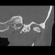 File:Adhesive chronic otitis media (Radiopaedia 14270-14148 Coronal bone window - left 4).jpg