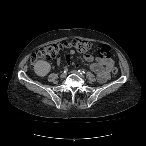 File:Adrenal collision tumor (ACT) (Radiopaedia 48462-53379 Axial non-contrast 40).jpg