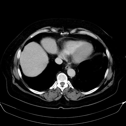 Adrenal cortical carcinoma (Radiopaedia 64017-72769 Axial C+ portal venous phase 5).jpg