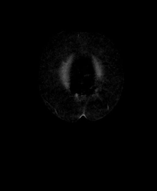 Adrenal cortical carcinoma (Radiopaedia 64017-72769 Coronal C+ delayed 4).jpg