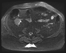 Adrenal cortical carcinoma (Radiopaedia 64017-72770 Axial DWI 81).jpg