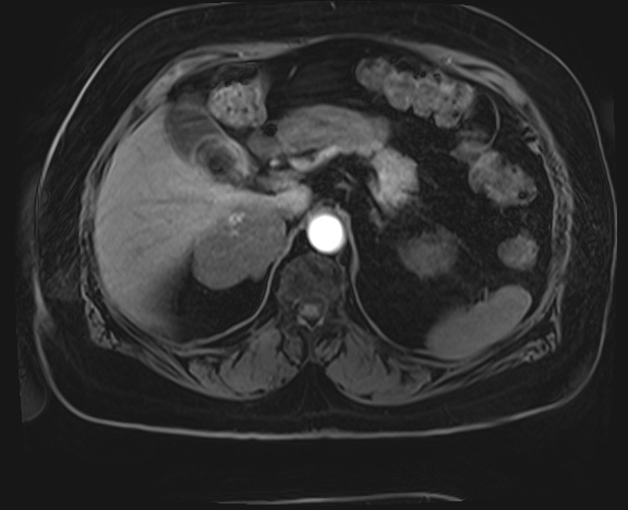 Adrenal cortical carcinoma (Radiopaedia 64017-72770 H 7).jpg