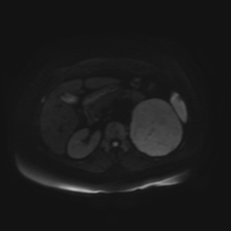 Adrenal cortical carcinoma (Radiopaedia 70906-81116 Axial DWI 41).jpg