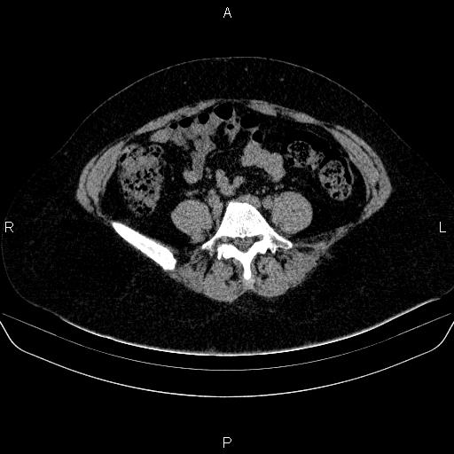 File:Adrenal cortical carcinoma (Radiopaedia 84882-100379 Axial non-contrast 62).jpg