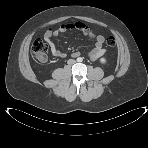 File:Adrenal cyst (Radiopaedia 45625-49778 AXIAL THICK 60 sec 62).png