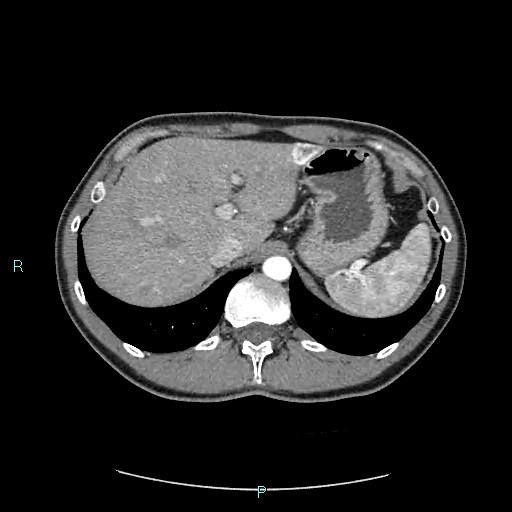 Adrenal cystic lymphangioma (Radiopaedia 83161-97534 Axial C+ arterial phase 22).jpg