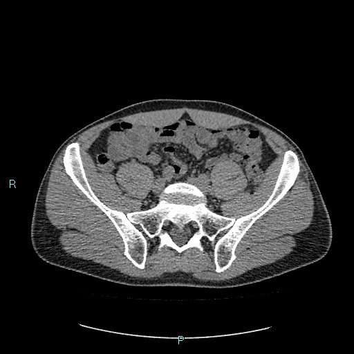 File:Adrenal cystic lymphangioma (Radiopaedia 83161-97534 Axial non-contrast 71).jpg