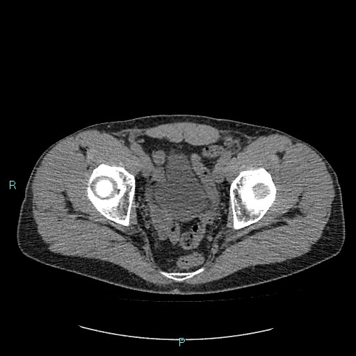 Adrenal cystic lymphangioma (Radiopaedia 83161-97534 Axial non-contrast 89).jpg