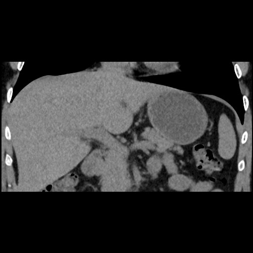 Adrenal gland trauma (Radiopaedia 81351-95079 Coronal non-contrast 41).jpg
