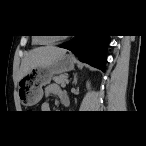 Adrenal gland trauma (Radiopaedia 81351-95079 Sagittal non-contrast 62).jpg