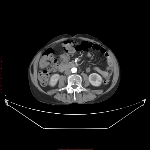 Adrenal hemangioma (Radiopaedia 68923-78668 Axial C+ arterial phase 41).jpg