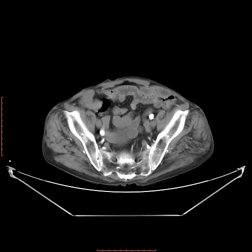 Adrenal hemangioma (Radiopaedia 68923-78668 Axial C+ arterial phase 60).jpg