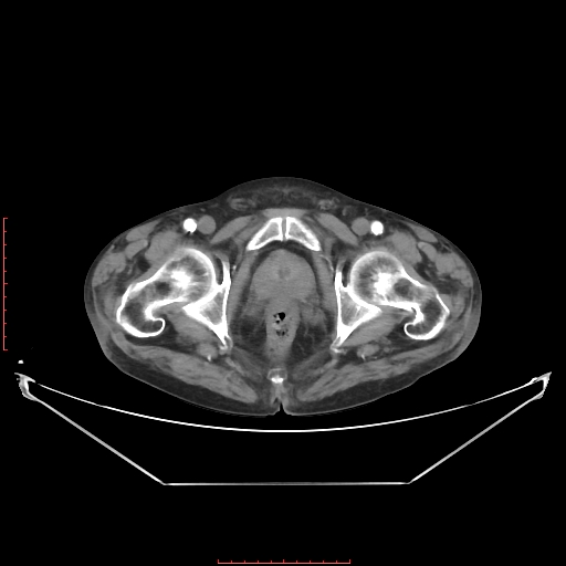 Adrenal hemangioma (Radiopaedia 68923-78668 Axial C+ arterial phase 72).jpg