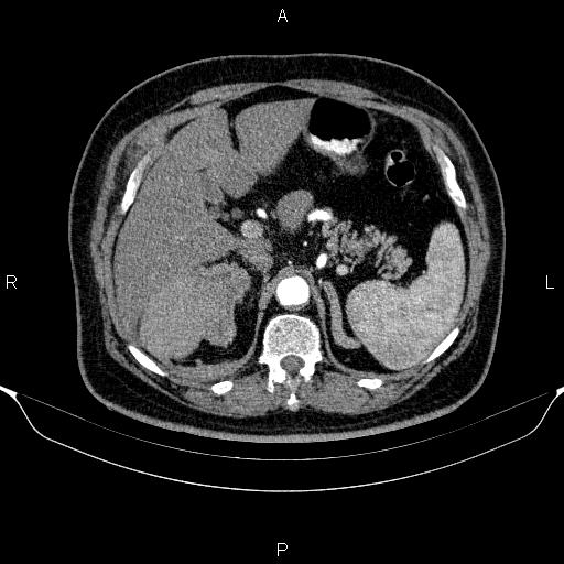 Adrenal hemorrhage (Radiopaedia 62622-70916 Axial C+ arterial phase 105).jpg
