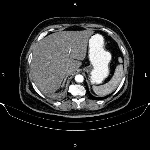 File:Adrenal hemorrhage (Radiopaedia 62622-70916 Axial C+ arterial phase 64).jpg